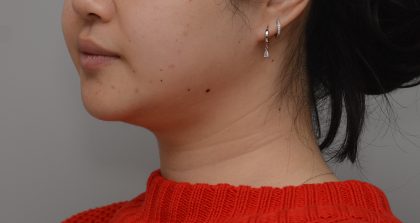 Neck Liposuction Before & After Patient #3656