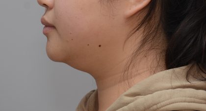 Neck Liposuction Before & After Patient #3656