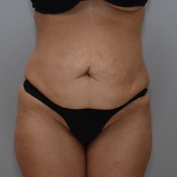 Abdominoplasty Before & After Patient #3681