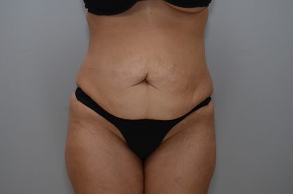 Abdominoplasty Before & After Patient #3681