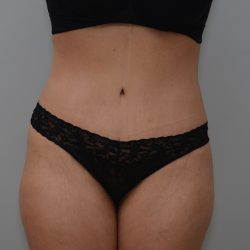 Abdominoplasty Before & After Patient #3681