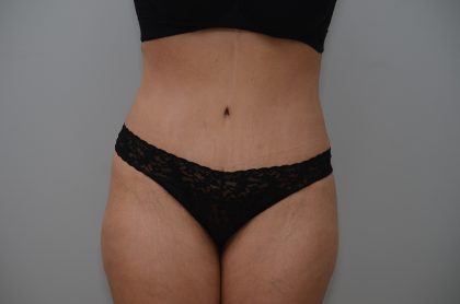 Abdominoplasty Before & After Patient #3681
