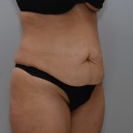 Abdominoplasty Before & After Patient #3681