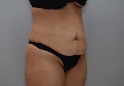 Abdominoplasty Before & After Patient #3681