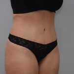 Abdominoplasty Before & After Patient #3681