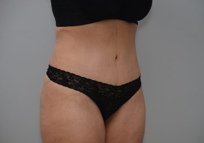 Abdominoplasty Before & After Patient #3681