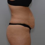 Abdominoplasty Before & After Patient #3681
