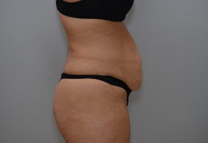 Abdominoplasty Before & After Patient #3681