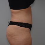 Abdominoplasty Before & After Patient #3681