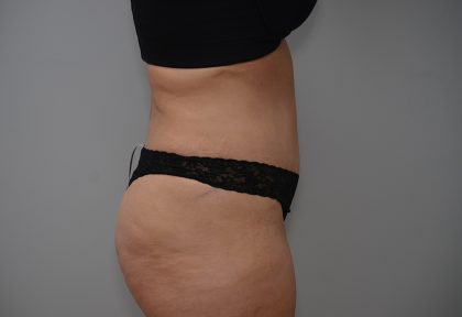 Abdominoplasty Before & After Patient #3681