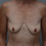 Breast Lift With Implants Before & After Patient #3692