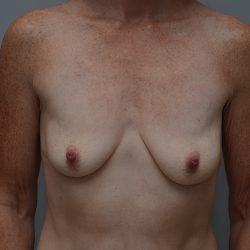 Breast Lift With Implants Before & After Patient #3692