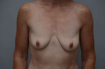 Breast Lift With Implants Before & After Patient #3692
