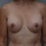 Breast Lift With Implants Before & After Patient #3692