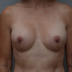Breast Lift With Implants Before & After Patient #3692