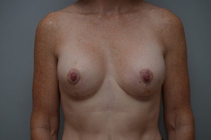 Breast Lift With Implants Before & After Patient #3692