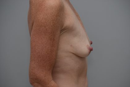Breast Lift With Implants Before & After Patient #3692