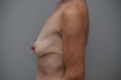 Breast Lift With Implants Before & After Patient #3692