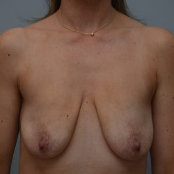 Breast Lift With Implants Before & After Patient #3703