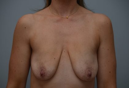 Breast Lift With Implants Before & After Patient #3703
