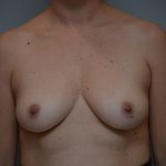 Breast Augmentation Before & After Patient #3714