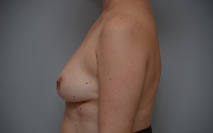 Breast Augmentation Before & After Patient #3714