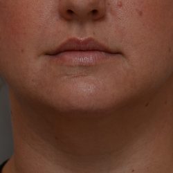 Neck Liposuction Before & After Patient #3725
