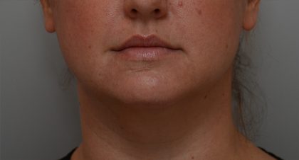 Neck Liposuction Before & After Patient #3725