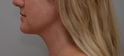 Neck Liposuction Before & After Patient #3725