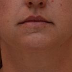 Neck Liposuction Before & After Patient #3725