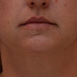 Neck Liposuction Before & After Patient #3725