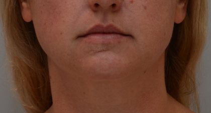 Neck Liposuction Before & After Patient #3725