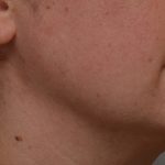Neck Liposuction Before & After Patient #3725