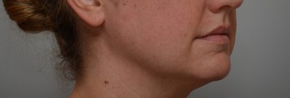Neck Liposuction Before & After Patient #3725