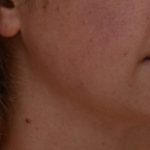 Neck Liposuction Before & After Patient #3725