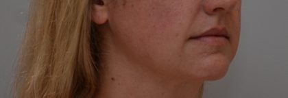 Neck Liposuction Before & After Patient #3725