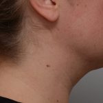 Neck Liposuction Before & After Patient #3725