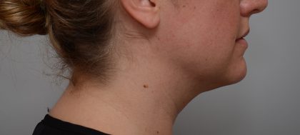 Neck Liposuction Before & After Patient #3725