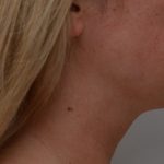 Neck Liposuction Before & After Patient #3725