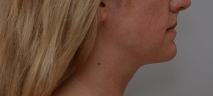 Neck Liposuction Before & After Patient #3725