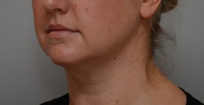 Neck Liposuction Before & After Patient #3725