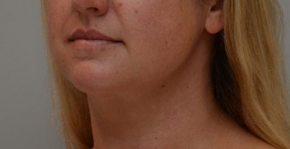 Neck Liposuction Before & After Patient #3725