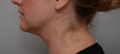 Neck Liposuction Before & After Patient #3725