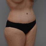Abdominoplasty Before & After Patient #3443