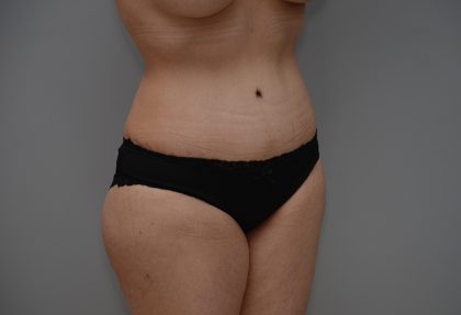 Abdominoplasty Before & After Patient #3443