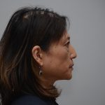 Blepharoplasty Before & After Patient #3421