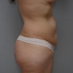 Abdominoplasty Before & After Patient #3443