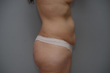 Abdominoplasty Before & After Patient #3443
