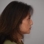 Blepharoplasty Before & After Patient #3421