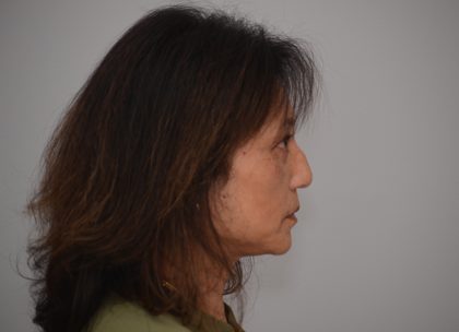 Blepharoplasty Before & After Patient #3421